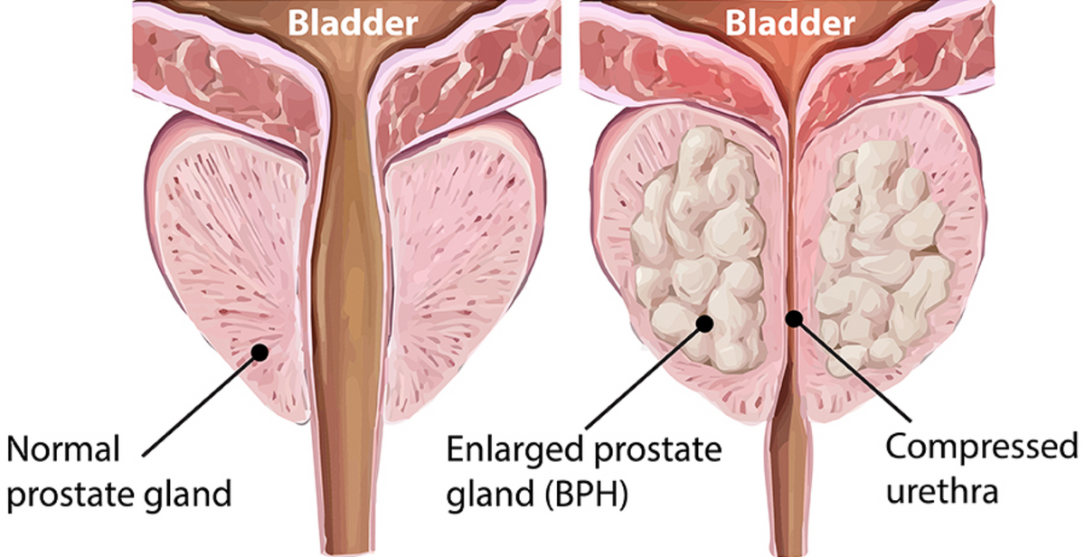Prostate mechanism diagram